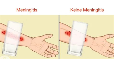 was ist eine meningitis